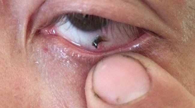 méhcsípés a szem elől myopia osztályozás