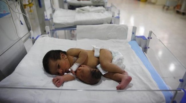 Parazita iker - Döbbenetes fotók: megoperálták a kétfejű babát (18+), Paraziták ikrek 14 év